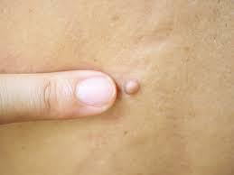 Skin Tag Removal Treatment Options: Expert Advice for Safe Removal