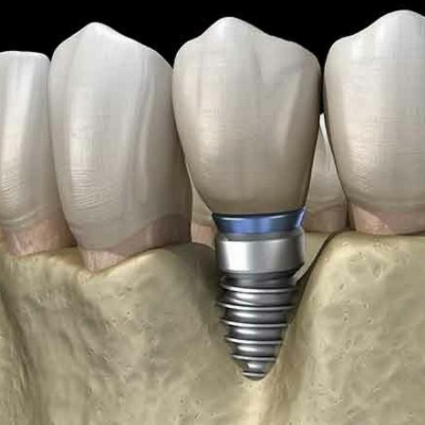 The Ultimate Guide to Dental Implants: What You Need to Know