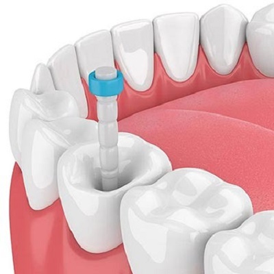 The Relationship Between Tooth Decay and Root Canal Treatment in Dubai