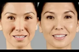 Dubai’s Fountain of Youth: Unveiling the Power of Juvederm Fillers